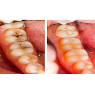Teeth Scaling and Polishing 