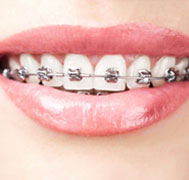 Care For Braces